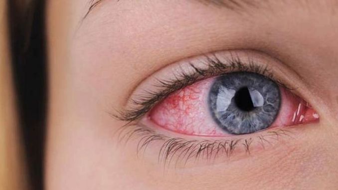 Glaucoma - Causes, Prevention & Treatment